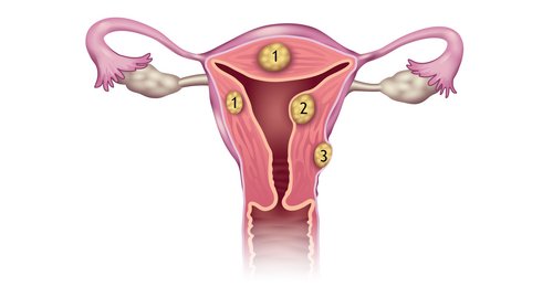 Myome in der Gebärmutterwand (1), unter der Schleimhaut (2) und an der Gebärmutteraussenwand (3) sind mit Sonata therapierbar.